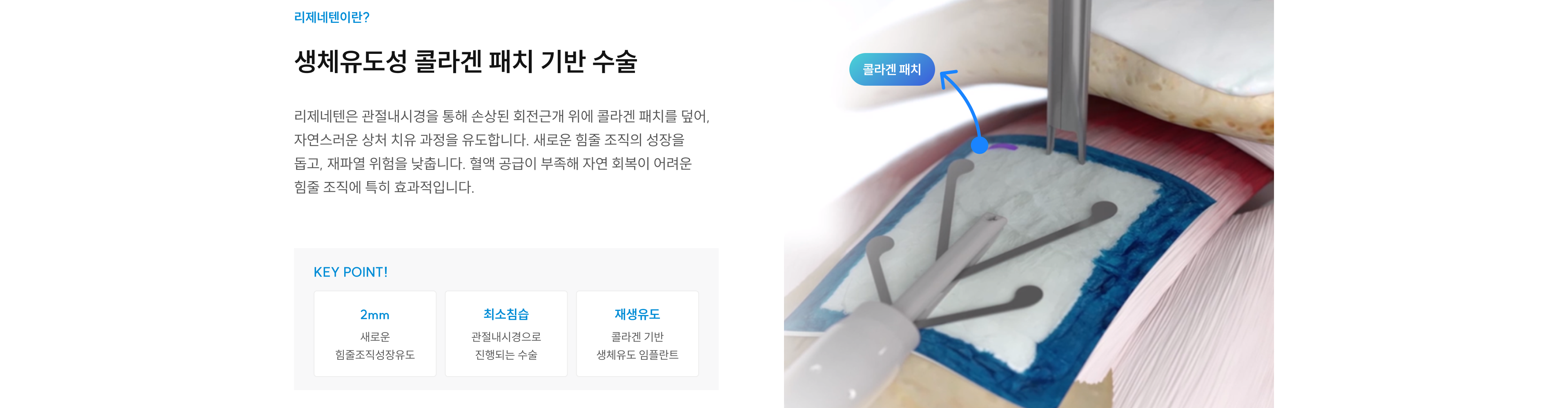 리제네텐이란? 생체유도성 콜라겐 패치 기반 수술 - 관절내시경으로 손상된 회전근개 위에 콜라겐 패치를 덮어 힘줄 재생 유도. KEY POINT: 2mm 새 힘줄조직 성장유도, 최소침습 관절내시경 수술, 콜라겐 기반 재생유도 임플란트