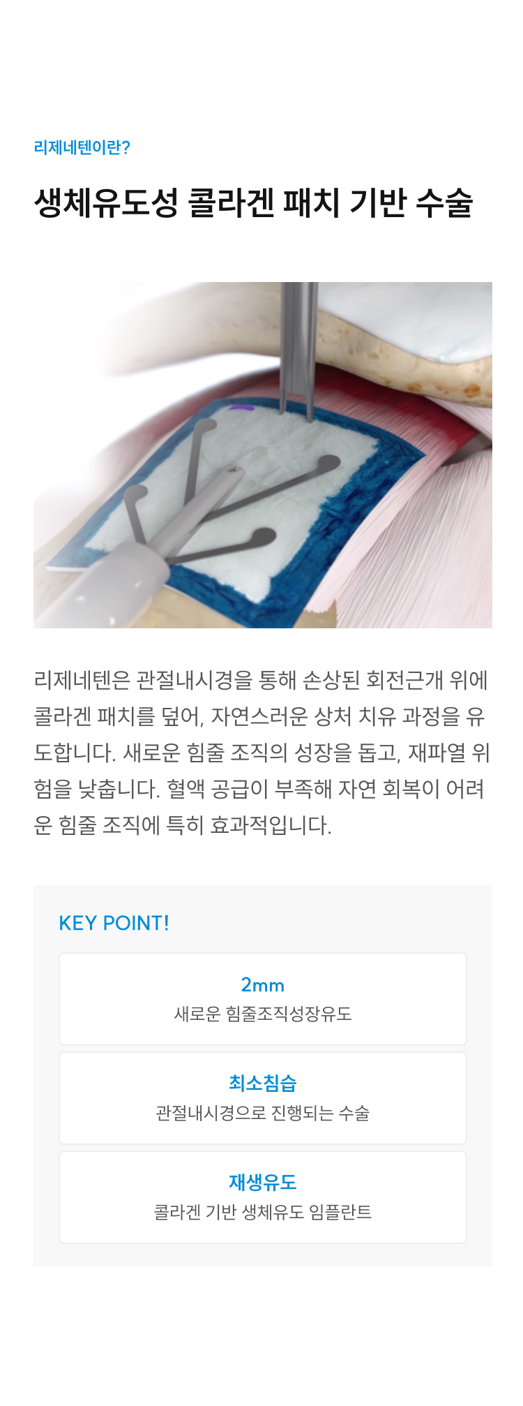 리제네텐이란? 생체유도성 콜라겐 패치 기반 수술 - 관절내시경으로 손상된 회전근개 위에 콜라겐 패치를 덮어 힘줄 재생 유도. KEY POINT: 2mm 새 힘줄조직 성장유도, 최소침습 관절내시경 수술, 콜라겐 기반 재생유도 임플란트