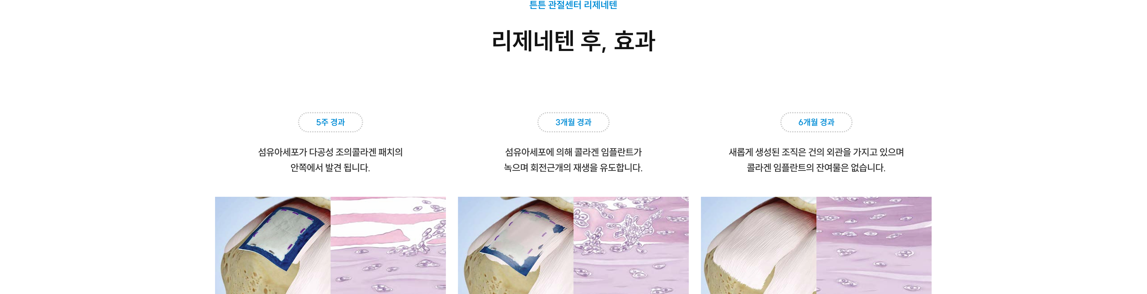 리제네텐 후 효과 - 5주 경과: 섬유아세포가 콜라겐 패치 안쪽에서 발견, 3개월 경과: 콜라겐 임플란트가 녹으며 회전근개 재생 유도, 6개월 경과: 새 조직이 건의 외관을 가지며 콜라겐 잔여물 없음