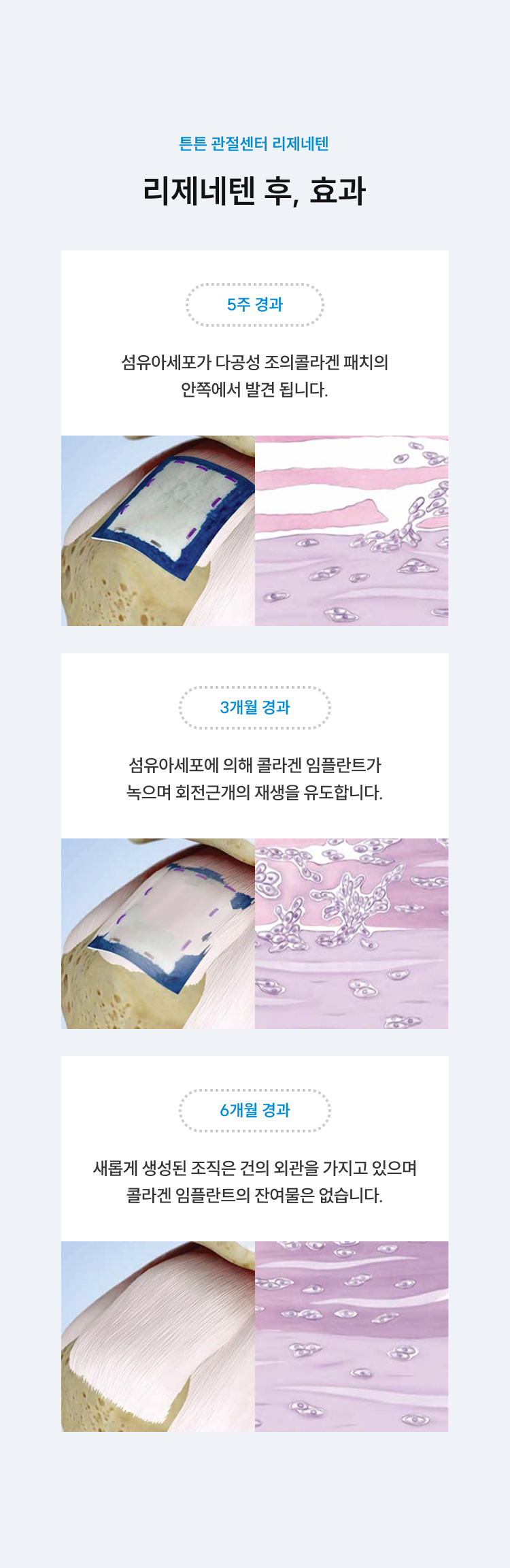 리제네텐 후 효과 - 5주 경과: 섬유아세포가 콜라겐 패치 안쪽에서 발견, 3개월 경과: 콜라겐 임플란트가 녹으며 회전근개 재생 유도, 6개월 경과: 새 조직이 건의 외관을 가지며 콜라겐 잔여물 없음