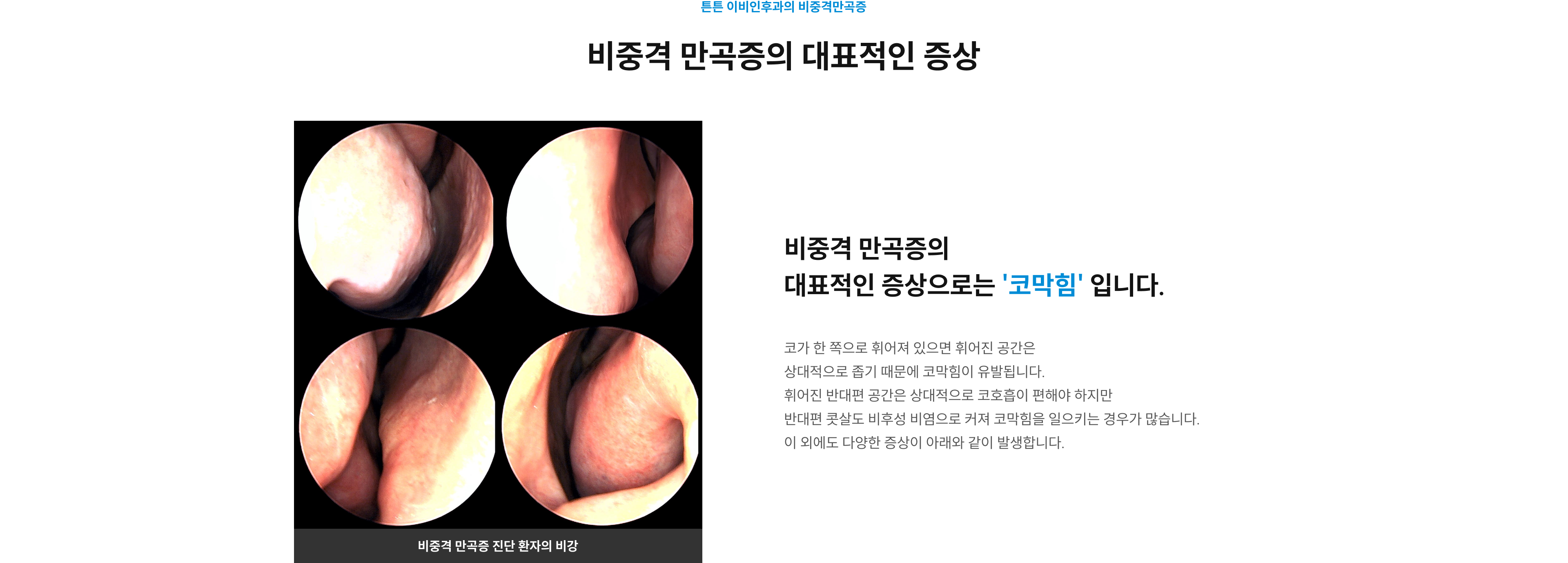 비중격 만곡증의 대표적인 증상은 코막힘 - 비중격 만곡증 진단 환자의 비강 내시경 사진