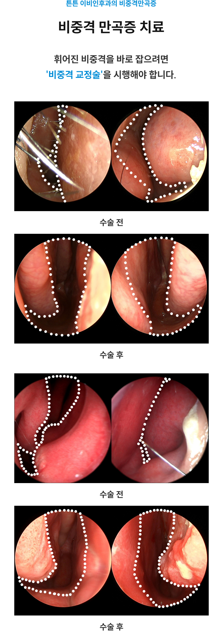 비중격 만곡증 치료 - 휘어진 비중격을 바로잡는 비중격 교정술 수술 전후 내시경 비교 사진