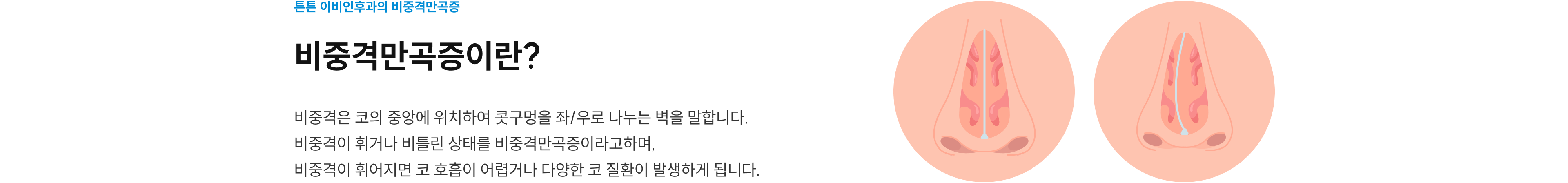 비중격만곡증이란? 콧구멍을 좌우로 나누는 비중격이 휘거나 비틀린 상태로, 코 호흡 장애와 다양한 코 질환을 일으킵니다