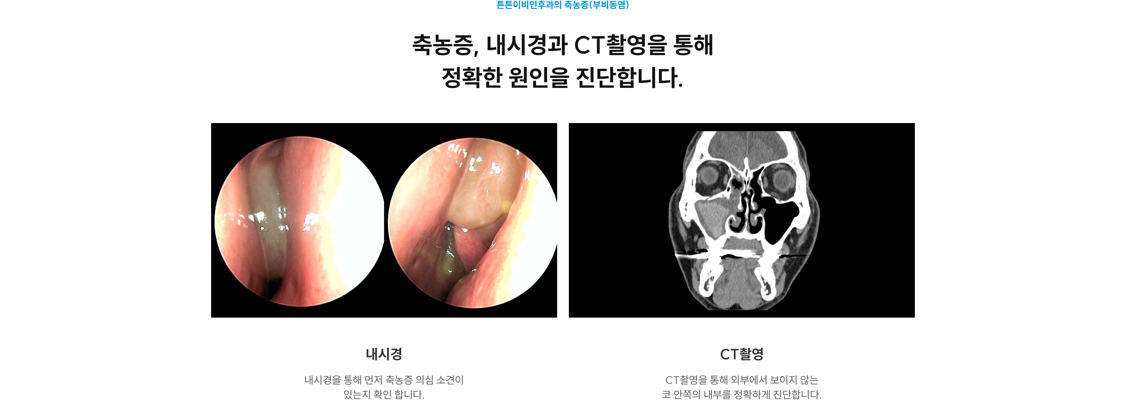 축농증, 내시경과 CT촬영을 통해 정확한 원인을 진단합니다