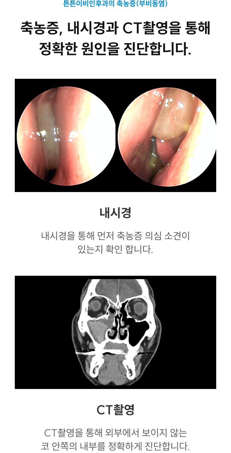 축농증, 내시경과 CT촬영을 통해 정확한 원인을 진단합니다