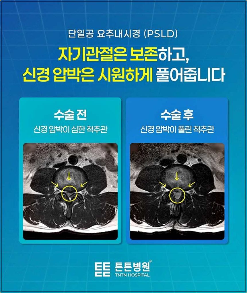 디스크 떼어내면 허리가 약해질까? 내시경 수술·입원·복귀 기준 관련 사진