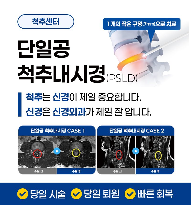 단일공내시경